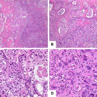 High Grade Transformation Of Epithelial Myoepithelial Carcinoma A Two