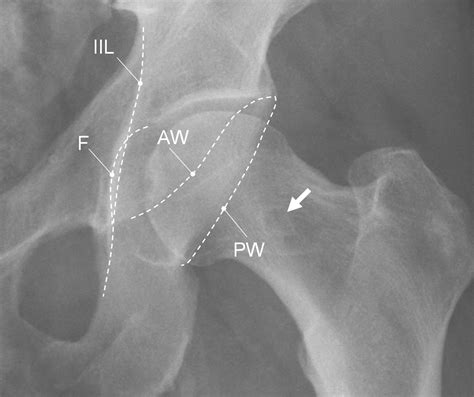 Femoroacetabular Impingement Radiographic DiagnosisWhat The