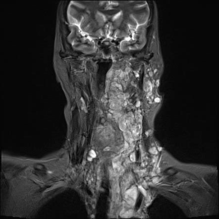 Plexiform Neurofibroma Radiology Reference Article Radiopaedia Org