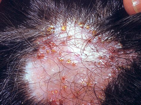 Candida Scalp