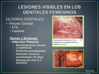 Lesiones Visibles En Los Genitales Femeninos Ppt