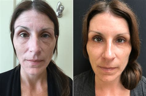 Botox Fillers Lasers Amazing Transformation Before And After Photos New Jersey Reflections