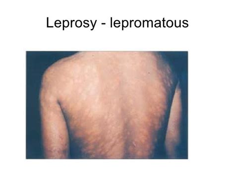 Tuberculosis And Leprosy