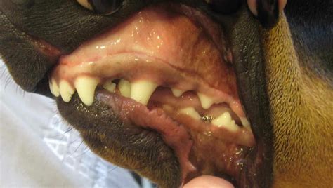 Overbite Type 2 Malocclusion