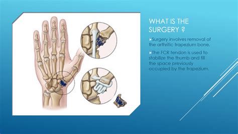 Basal Thumb Arthritis Explained By Dr Anzarut Youtube