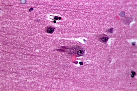 Neurofibrillary Tangles