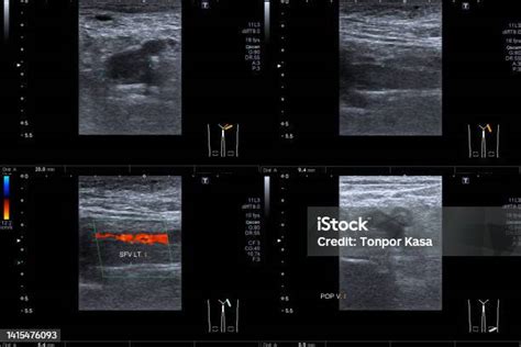 Doppler Ultrasound Of Deep Vein Thrombosis Superficial Femoral Vein Left Thigh Medical ...