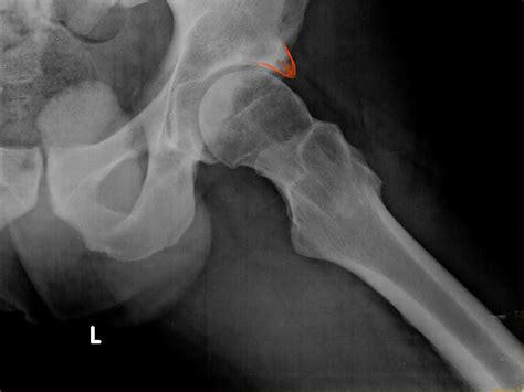 Femoral Acetabular Impingement Sport Med School