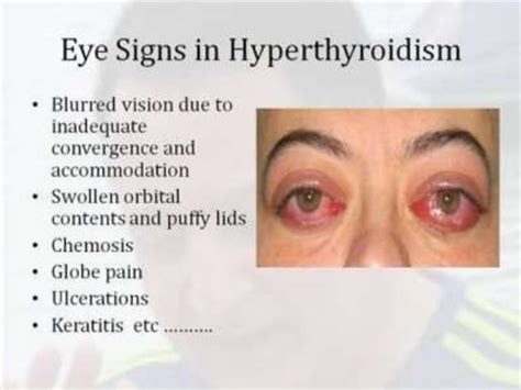 Hyperthyroidism Part 2 By Dr Bashir Associate Professor Medicine Sopo