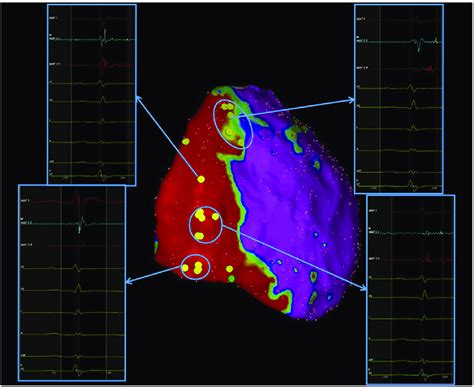 Epicardial Bipolar Voltage Mapping And The Distribution Of Abnormal