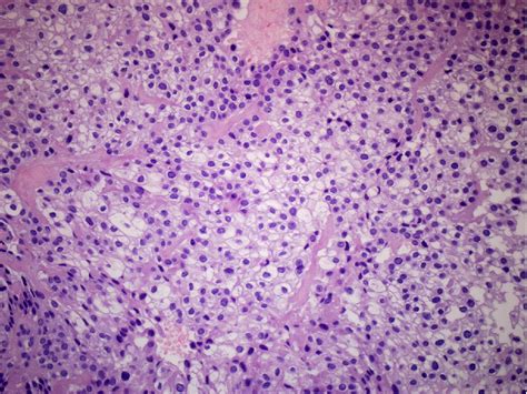 Hyalinizing Clear Cell Carcinoma A Case Report And Review Of The