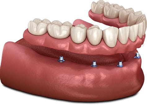 Fixed Vs Removable Teeth Florence Louisville KY