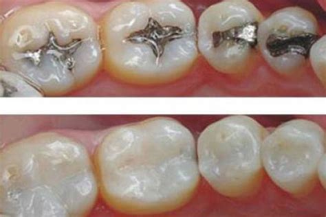 What causes pain after dental filling | Nation