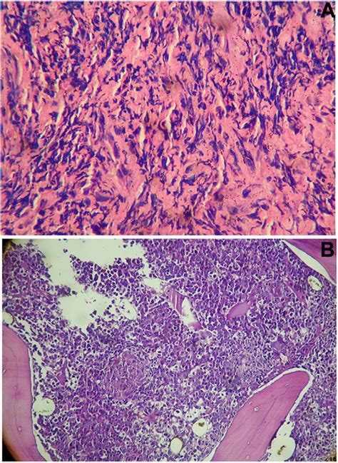 A B Photographs Of Histopathology Slides Of Vertebral Biopsy