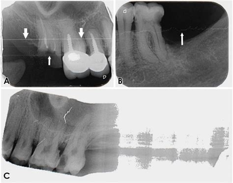 Determination And Classification Of Intraoral Phosphor Storage Plate