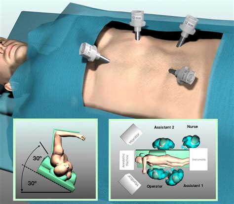 Transperitoneal Laparoscopic Adrenalectomy Outline Of The Preoperative