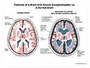 Medivisuals Anoxic Brain Injury Animation Part