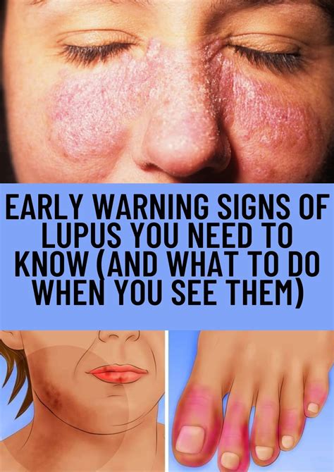 Early Warning Signs Of Lupus You Need To Know And What To Do When You See Them Wellness Days