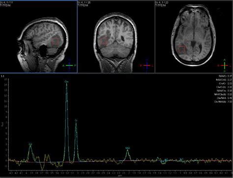 Figure 12 From Advanced Magnetic Resonance Imaging In Glioblastoma A