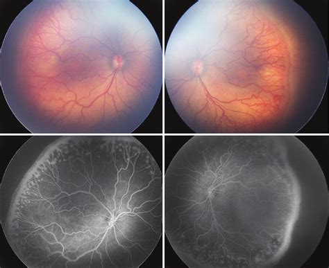 Wide Field Fundus Imaging And Fluorescein Angiography In Retinopathy Of