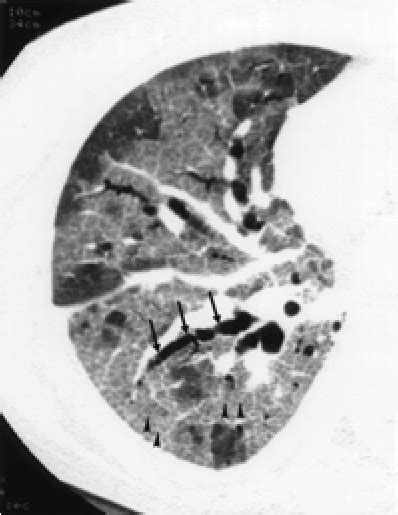 Bronchiolitis Obliterans Organizing Pneumonia In A 51 Year Old Woman Download Scientific