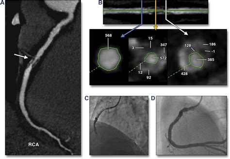 High Risk Plaque Features On Coronary Ct Angiography Jacc