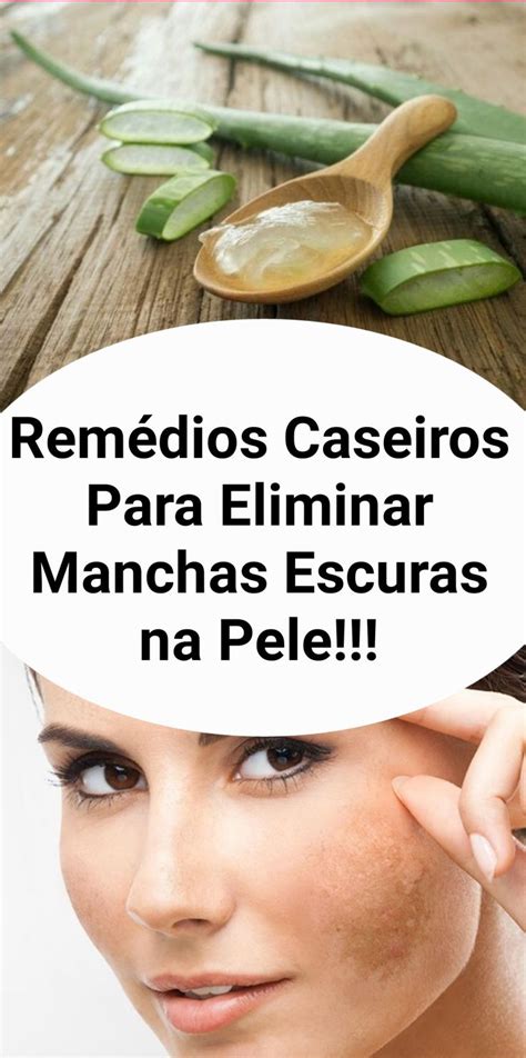 Rem Dios Caseiros Para Eliminar Manchas Escuras Na Pele Tratamento