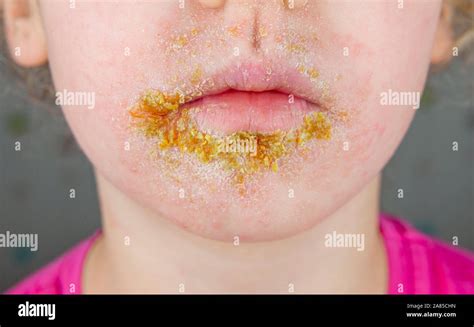 Impetigo In Children Face