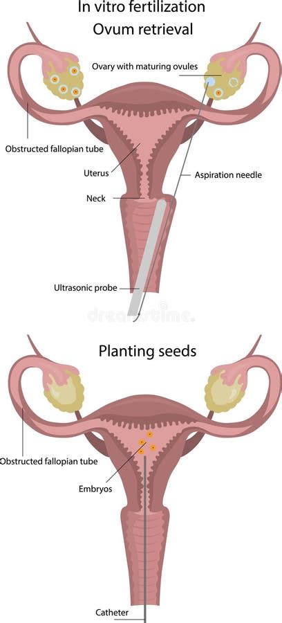 In Vitro Fertilization Obtaining An Egg For Artificial Insemination