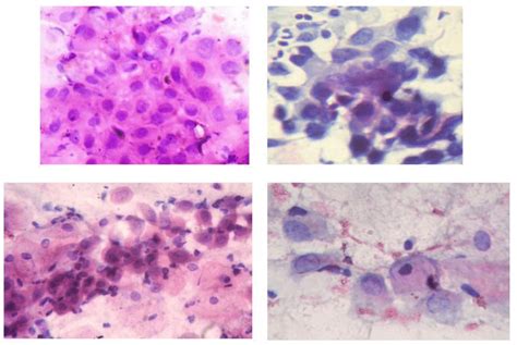 A D Low Grade Squamous Intraepithelial Lesion A Conventional Pap