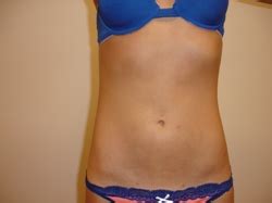 Tampa Bay Tumescent Liposuction Specialist Dr Andres Bonelli