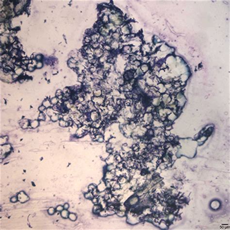 Figure A Bone Marrow Impression Smear Wright S Stain X Eclinpath