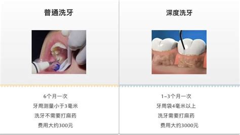 每天刷牙為什麼還會長牙結石？ 每日頭條