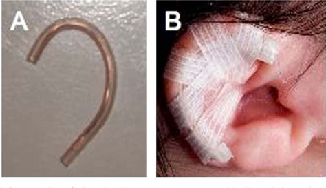 Figure 3 From Identification Of Congenital Auricular Deformities During