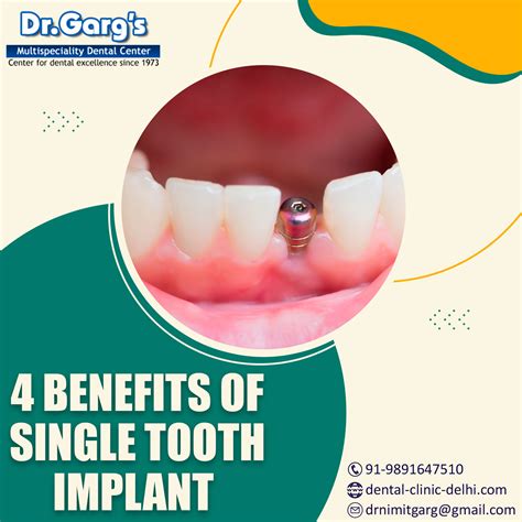 4 Benefits of Single Tooth Implant