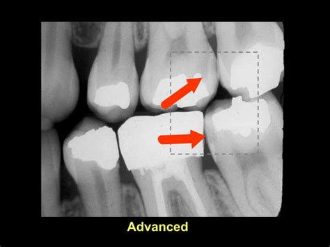 Radiographic Diagnosis Of Dental Caries