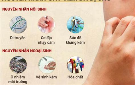 3 Cách Trị Viêm Da Dị ứng Tại Nhà Mà Bạn Nên Tham Khảo Cây Cảnh