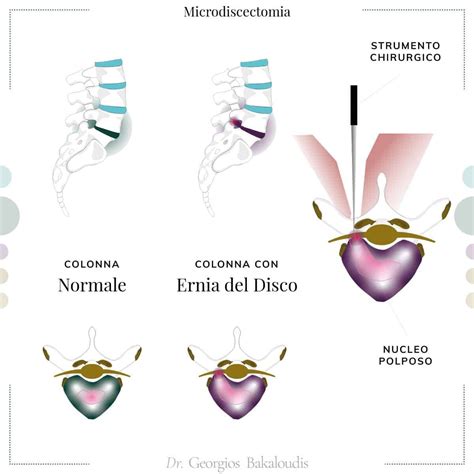 Protrusione Discale Localizzazione Sintomi Cause E Cure