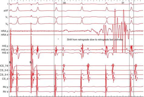 AV Nodal Reentrant Tachycardia Atypical Basicmedical Key