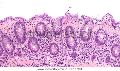 Microscopic Colitis: Over 79 Royalty-Free Licensable Stock Photos ...