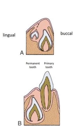 Chapter 6 Eruption And Shedding Of The Teeth Flashcards Quizlet