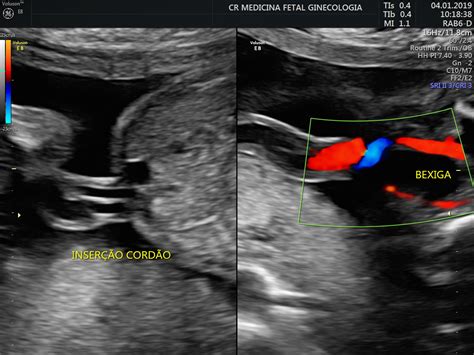 Anomaly Scan Cr Fetal Medicine