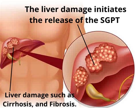 High Sgpt Alt Test Results Meaning Explained By Off