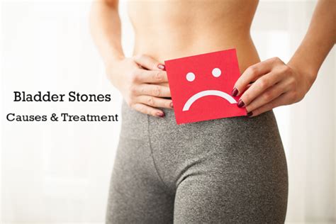 What Are Bladder Stones? Causes and treatment | Dr. Irfan Shaikh ...