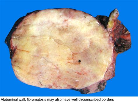 Pathology Outlines Fibromatosis Desmoid