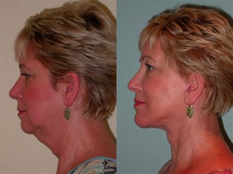 Face and Neck Lift Plastic Surgery in Santa Rosa