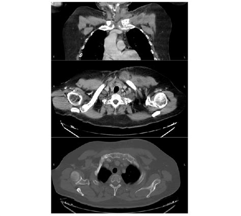 Chest Computed Tomography Scan On Admission Showing Left Download Scientific Diagram