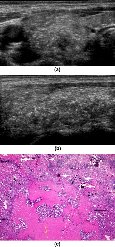 Diffuse Sclerosing Variant Of Papillary Carcinoma Of The Thyroid