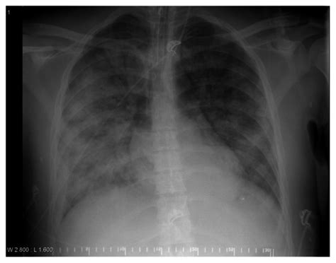 Chest X Ray Displaying Opacities Consistent With Acute Respiratory