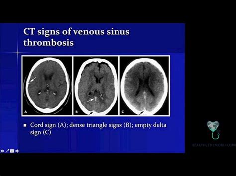 Transverse Sinus Thrombosis